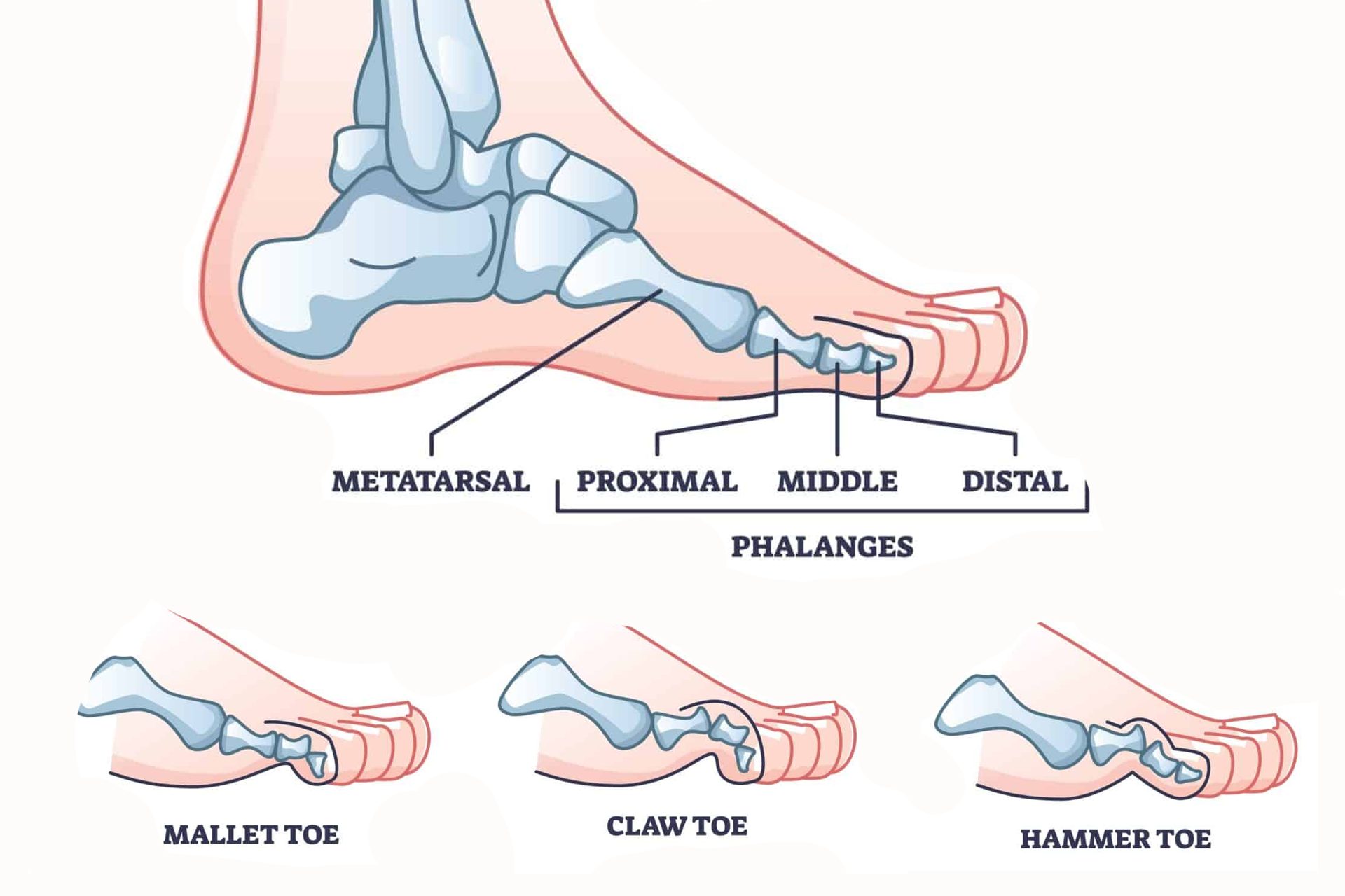Claw / Hammer toes
